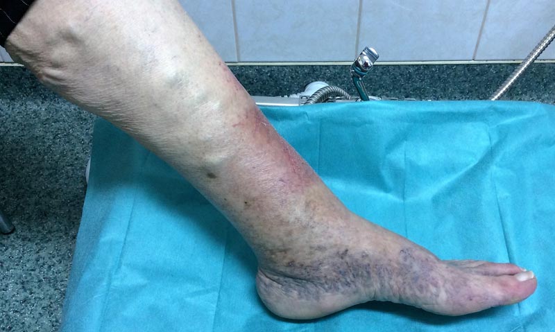 sebek jelennek meg a lábak varikózisában