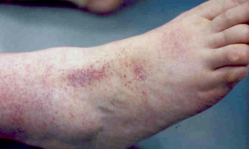 láb bőrpír cukorbetegség kezelésének