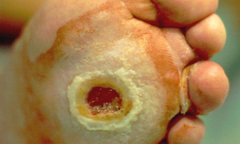 Cukorbeteg lábon kialakult sebek és fekélyek