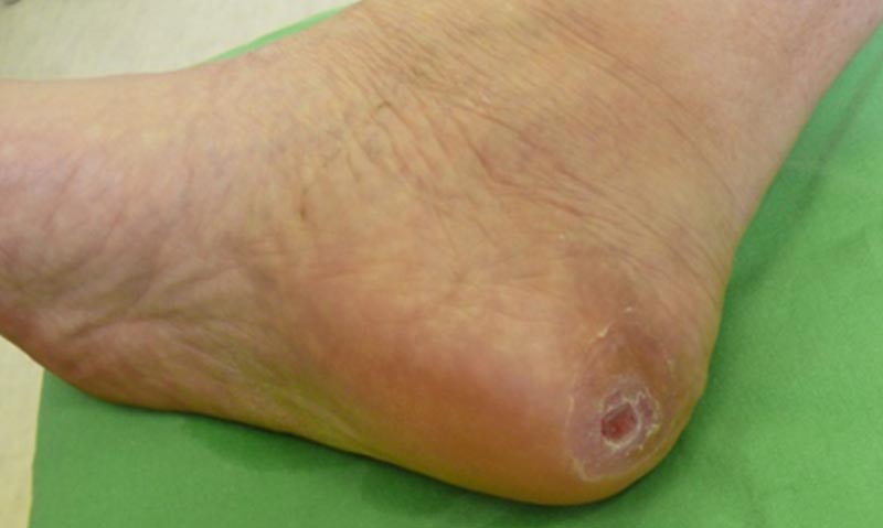a lábak lábán lévő sebek kezelése cukorbetegségben)