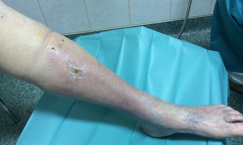 mazi a sebek cukorbetegségével a seb lábakon és a kezelésükön