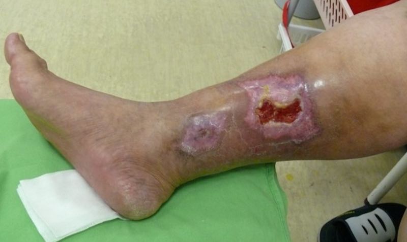 kezelése nem gyógyuló sebek diabetes mellitus a láb sérülések és kezelésük