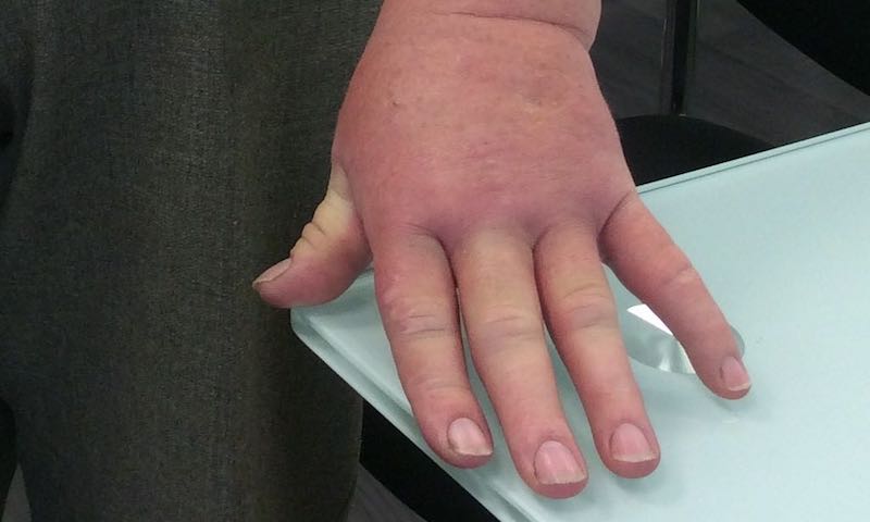 ujjak együttes kezelése